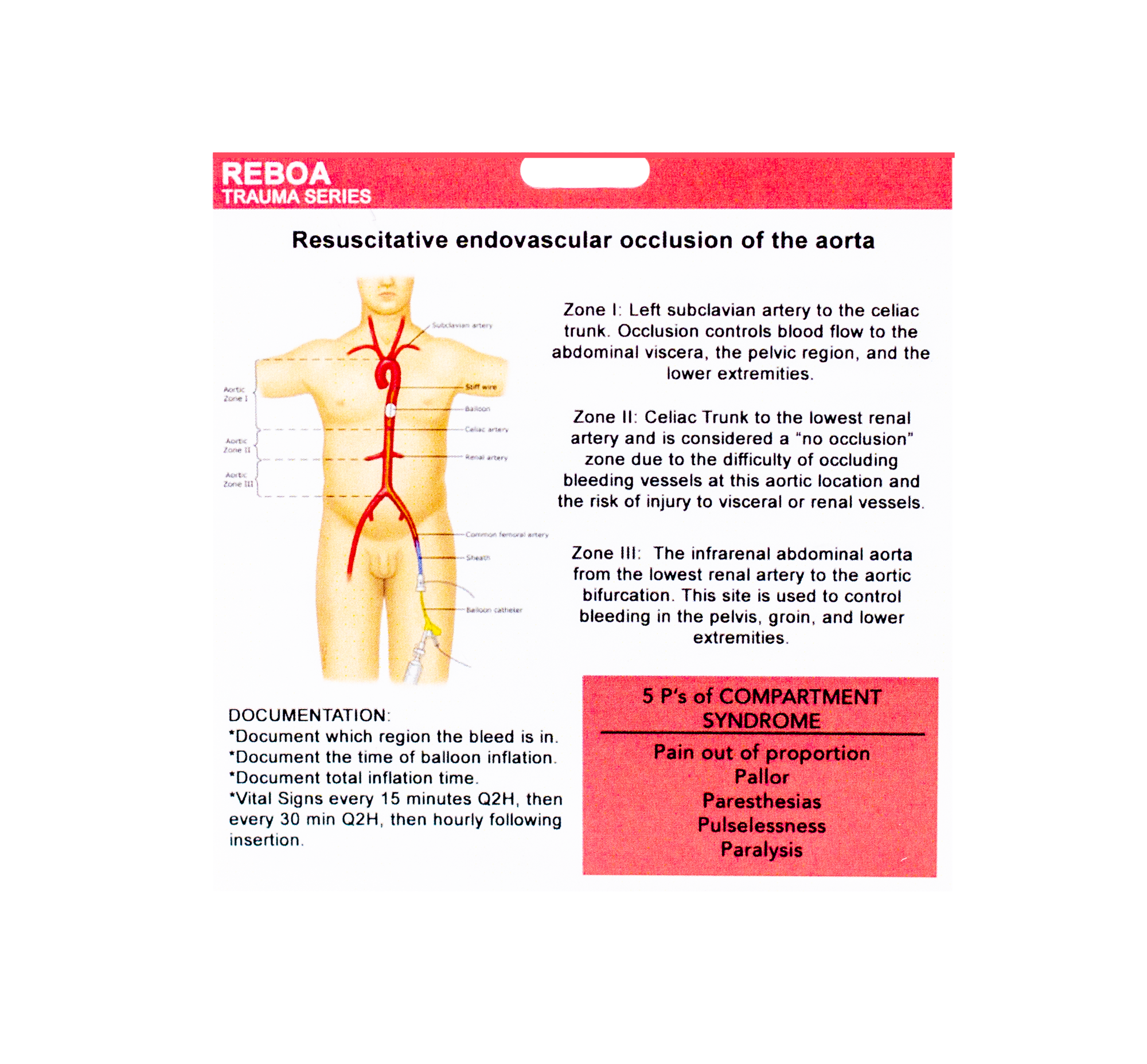 Side one of our REBOA badge buddy contains the zones of placement, documentation, and the 5 P's of compartment syndrome. 