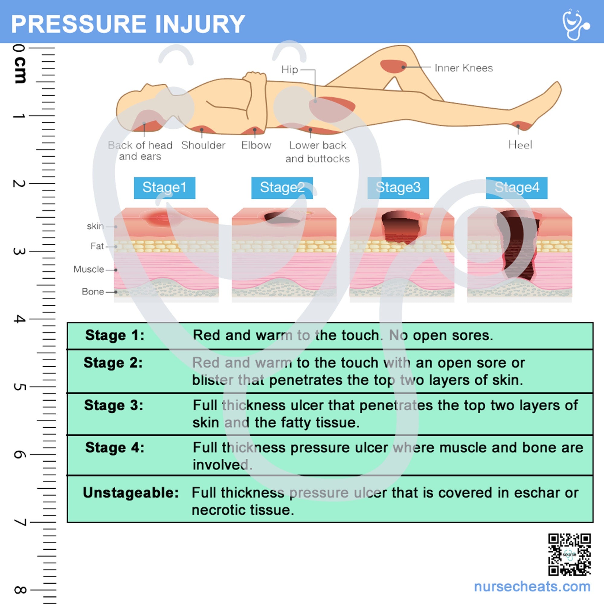 Side two of our Wound care badge buddy contains pressure injury classification as well as staging.